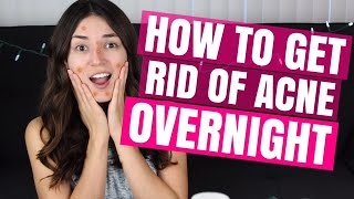 HOW TO GET RID OF ACNE OVERNIGHT  Mercades Danielle [upl. by Ahcsatan]