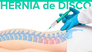 Cuál es el MEJOR TRATAMIENTO para la hernia discal 🦾 Hernia de disco [upl. by Auqkinahs564]