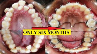 How to fix crowded teeth I Treatment for crooked teeth [upl. by Kutzer]