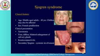 SRM Dental College Ramapuram  Sjogrens Syndrome  DrVasanthiV  Senior Lecturer [upl. by Fleeman]