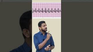 Supraventricular tachycardia ytshorts ecg fmge usmle plab mbbs [upl. by Adaliah]