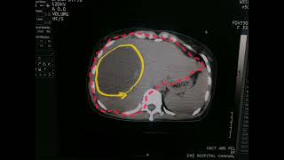 Pyogenic abscess of Liver  Findings of Liver on CT  Abdominal Scan  Liver plain CT Scan  Part 1 [upl. by Westerfield]