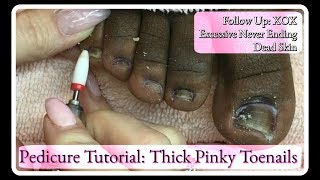 Excessive Never Ending Dead Skin Follow Up Pedicure Tutorial EFile Pinky Toenails [upl. by Nylorac]