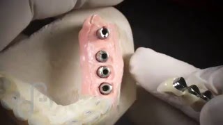 Cementado en implantes con intraoral2º video Dental Campus [upl. by Alisun]