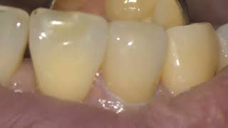 Ceramic crown set in anterior maxilla [upl. by Light481]