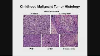 Precision Medicine Strategies for Medulloblastoma Therapy [upl. by Kincaid]