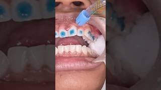 Braces Orthodontic Bracket Placement Procedure orthodontics dentalclinic dentist dentistry [upl. by Niuqaoj]