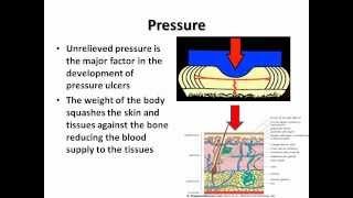 Preventing Pressure Ulcers a SKIN Bundle approach for Community Carers [upl. by Acacia]