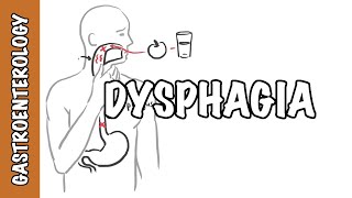 Approach to dysphagia difficulty swallowing  causes pathophysiology investigation [upl. by Bonni]