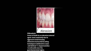 tooth wear non carious lesionsattritionerosionabrasionabfractiontooth basic dentaldentist [upl. by Hniv]