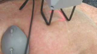 Fractional CO2 Laser [upl. by Leisha]