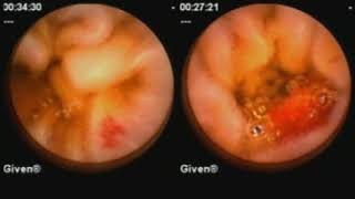 Imaging and Enterography of the Small Bowel [upl. by Ohs]