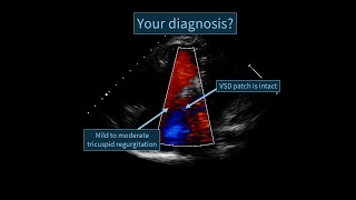 An echocardiographic case of a surgically treated Tetralogy of Fallot [upl. by Anthony]