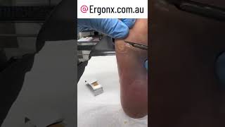 Satisfying corn and callua removal by podiatrist in clinic by cutting with scalpel [upl. by Sualohcin458]