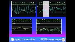 Cardiac Tamponade Case Vignette [upl. by Akcira]