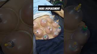 Navel displacement treatment by vaccum cupping naveldisplacementtreatment vaccumcupping shorts [upl. by Dam]