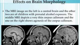 Biological Effects of Alcohol on the Developing Embryo and Fetus [upl. by Ardnuaet]