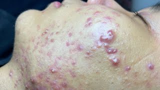 ACNE TREATMENT VU QUYNH MI Blackheads On Boy Face 2024 [upl. by Nedroj593]