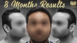 Amazing Hair Transplant Journey  8Month Hair Transplant Results  MedLinks [upl. by Settle]