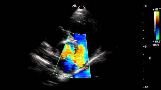 Colour Doppler Echocardiography [upl. by Anurag]