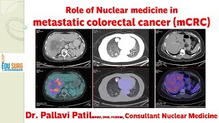 Role of PET scan Nuclear Medicine in the management of stage IV colon cancer and rectal cancer [upl. by Gladine875]