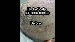 HydraScalp for tinea capitisseborrheic dermatitis [upl. by Melany]