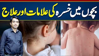 Measles Symptoms amp Treatment  Measles Treatment For Babies  Khasra Ki alamat Aur ilaj [upl. by Akirrehs]