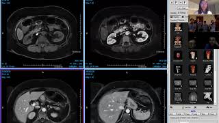 Enhancing pancreatic mass causing ductal dilation  differential please Victoria Chernyak [upl. by Sivahc]