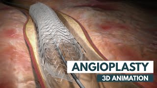 Angioplasty  3D Animation  Real Footage [upl. by Yeca]