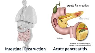 Intestinal Obstruction ampacute pancreatitis in emergency تتصرف ازاى وانت فى الاستقبال [upl. by Sigfried]