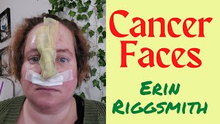 Cancer Faces Erin Riggsmiths Journey with Basal Cell Carinoma Removal with Forehead Flap Closure [upl. by Haimerej51]