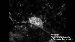 Voltagegated calcium channel autoimmune cerebellar degeneration 12 [upl. by Lenni454]