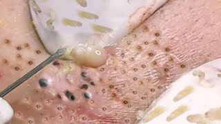 NEW Pimple Popping Compilation  Blackheads removal  Pimple removal vids of 2021 [upl. by Ordisy]