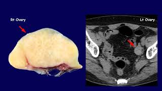 Solid ovarian tumors 12  Brenner tumor [upl. by Valentijn]