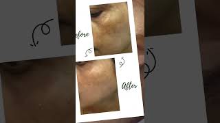 Cosmelan Peel Treatment [upl. by Weld645]