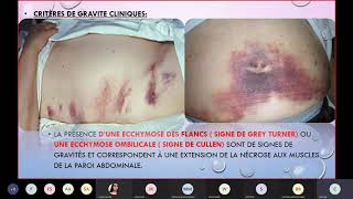 Chirurgie générale pancréatite aigüe [upl. by Kciremed357]