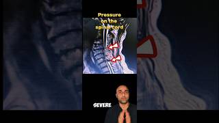 Cervical Myelopathy explained neckpain spine surgeon cervical awareness cervicalpain shorts [upl. by Snook]