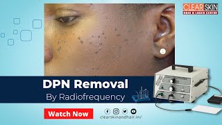 DPN Removal Treatment By Radiofrequency Device  Laser Treatment for Removing of DPN  DrNKailash [upl. by Tracee]