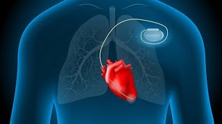 Placement of a pacemaker on the patients ♥ [upl. by Niwde]