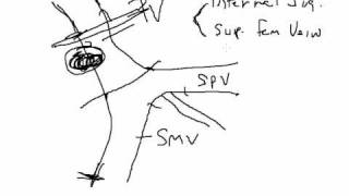 Cancer of the Pancreas Whipple Procedure with Portal Vein Resection [upl. by Alaek]