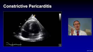 Treatment of Complicated Pericarditis [upl. by Lledniw992]