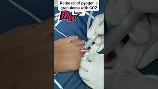 Removal of pyogenic granuloma with CO2 laser [upl. by Dnomhcir]