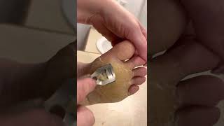 Feet Shaving Ball of Foot  Jan 12 2023  Diffuse Epidermolytic Palmoplantar Keratoderma [upl. by Talyah]