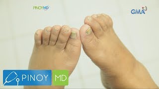 Pinoy MD Solusyon sa nail fungus alamin [upl. by Nwad433]