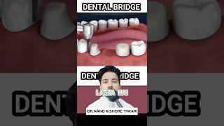 Dental BRIDGE procedure  Dental BRIDGE kaise BANTA HAI ❓shorts dental [upl. by Evonne511]