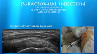 Ultrasound guided Subacromial injection from probeultrasoundcom [upl. by Laamaj]