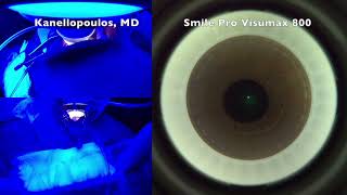 Visumax 500 and 800 the evolution of Smile to Smile pro Kanellopoulos MD [upl. by Clayberg]