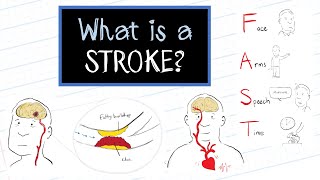 What is a Stroke HealthSketch [upl. by Vyse]