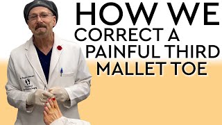 How We Correct A Painful Third Mallet Toe [upl. by Farley]