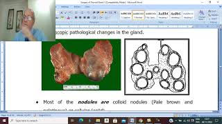 Thyroid disorders in Arabic 5  Simple nodular goiter  part 1   by Dr Wahdan [upl. by Chet]